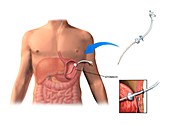 Feeding tube,artwork