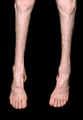 Charcot-Marie-Tooth disease