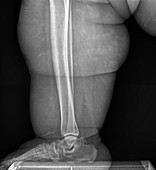 Obesity,X-ray