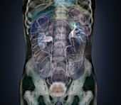 Healthy abdomen,composite CT scan