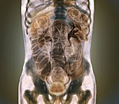 Healthy abdomen,composite CT scan