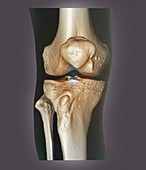 Healthy knee,3D CT scan