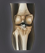 Healthy knee,3D CT scan