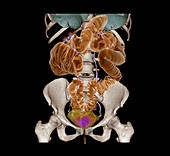 Diverticulosis,3D CT scan