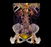 Abdominal aneurysm,3D CT angiogram