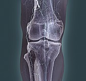 Thrombosis,3D CT angiogram