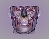 Human head,cone beam CT scan