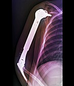 Total upper arm bone replacement,X-ray