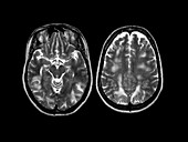 Eclampsia,MRI scan