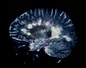 Multiple sclerosis,MRI scan