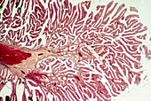 Rectal tumour,light microcraph