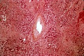 Budd-Chiari syndrome,light micrograph