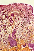 Intestinal cancer,light micrograph
