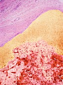 Testicular cancer,light micrograph