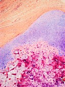 Testicular cancer,light micrograph