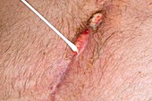 Swabbing infected heart bypass wound
