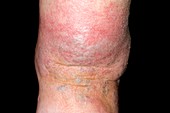 Cellulitis affecting the ankle