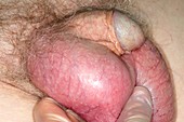 Swollen testicles caused by a catheter