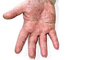 Eczema on hand of a young boy
