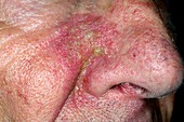 Seborrheic dermatitis on the nose