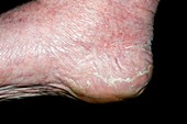 Exfoliative dermatitis on the foot
