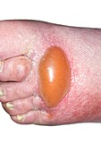 Blister on the foot in arterial disease