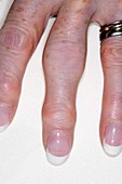 Osteoarthritis of the fingers