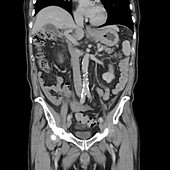 CT scan showing stomach cancer