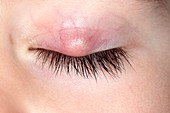 Stye on upper eyelid