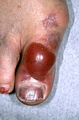 Fractured big toe