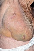 Seroma after breast surgery