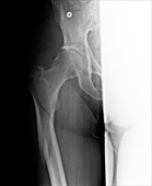 X-ray of fractured femur