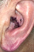 Shingles in the ear