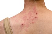 Shingles on the neck
