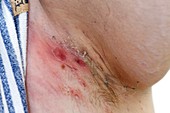 Hidradenitis in adult armpit