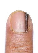 Fingernail with melanonychia
