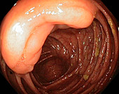 Ileocaecal valve,endoscope view