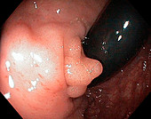 Perianal polyp,endoscope view