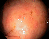 Colitis,endoscope view