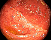 Ileocolonic anastomosis,endoscope view