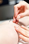 Acupuncture treatment