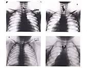 Swallowed trinkets,X-rays