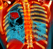 Lung cancer,CT scan