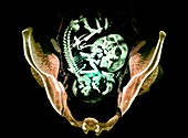 Twin foetuses,CT scan
