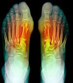 Gout,X-ray