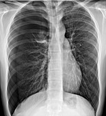 Tension pneumothorax,X-ray