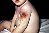 Hypogammaglobulinemia in a child,1968