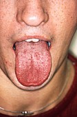 Syphilis in the mouth
