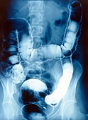 Normal colon,barium X-ray