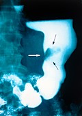 Stomach cancer,X-ray